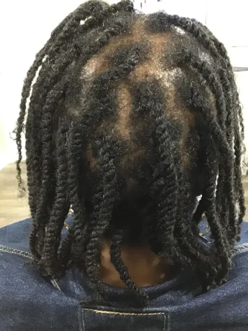 The same crown after 22 weeks of treatment