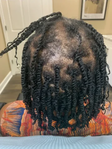 Hormonal thinning at the crown before treatment
