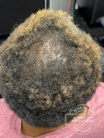 The same crown after 30 weeks of treatment