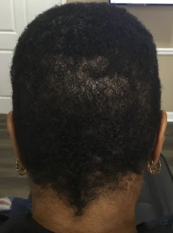 The same part after 18 weeks of treatment