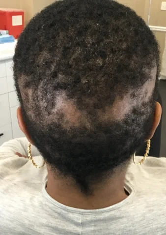 Telogen effluvium thinning at the part before treatment