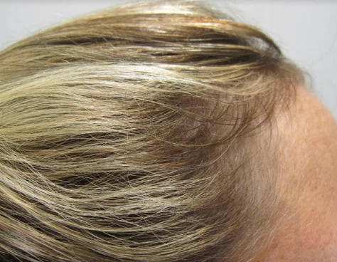The same part and crown after 32 weeks of treatment