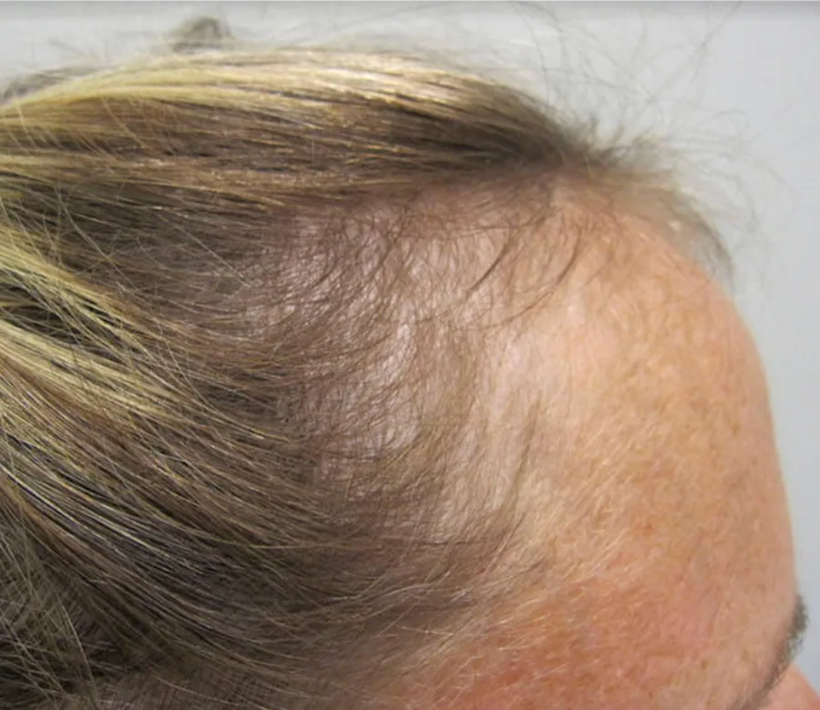 Female pattern hair loss at the part and crown before treatment