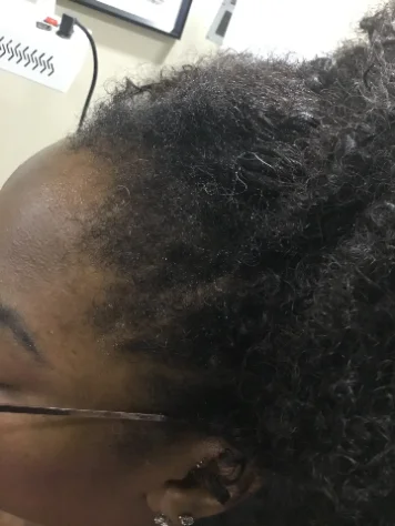 The same hairline after 31 weeks of treatment