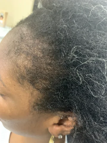 Traction alopecia along the hairline before treatment