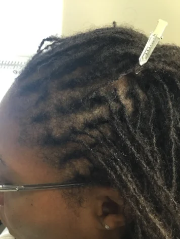 The same scalp after 34 weeks of treatment