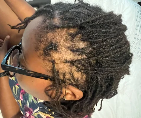 Alopecia areata patches before treatment