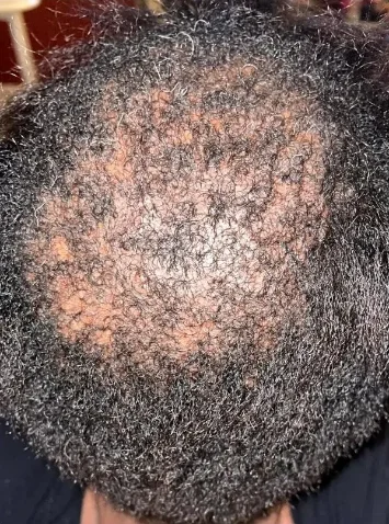 Early scarring alopecia before treatment