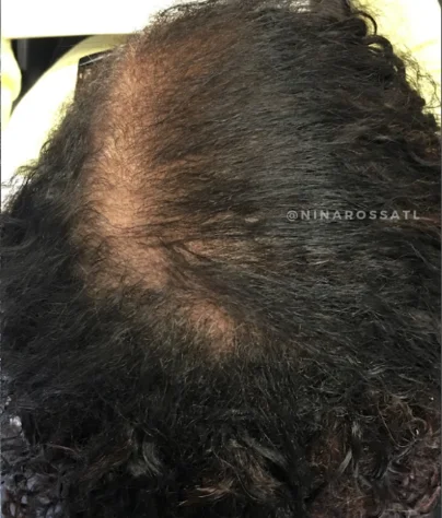 The same crown after 26 weeks of treatment