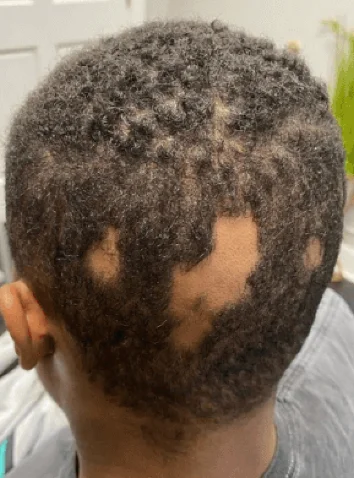 Telogen effluvium shedding before treatment