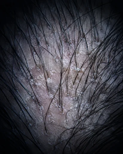 Follicles seen through the 200x scalp camera